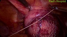 Laparoscopic Pelvic Prolapse Surgery 