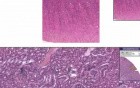 Nephrocalcinosis - Histopathology - Kidney