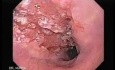 Esophageal Squamous Cell Carcinoma (1 of 2 )
