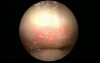 Herpes Simplex Oralis