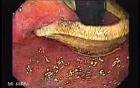 Penetration of Adjustable Laparoscopic Gastric Banding (3 of 4)