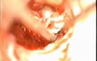 Glomus Tympanicum tumor Excision - Part 2: Removal Of tumor, Reconstruction