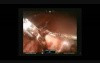 Robotic Hysterectomy with Cholecystectomy
