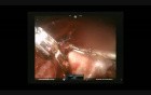 Robotic Hysterectomy with Cholecystectomy