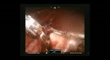 Robotic Hysterectomy with Cholecystectomy