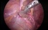 Pedriatric laparoscopic hernia repair.