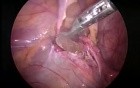 Pedriatric laparoscopic hernia repair.