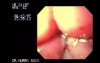 Tear of Gastroesophageal Junction Mucosa - 42  Years-Old Male