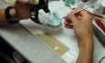 Dental Implants - Poor Implant Position