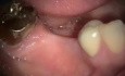 Implant Microsurgery Transition From A Failing Bridge