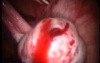 Intraperitoneal Haemorrhage From A Ruptured Corpus Luteum