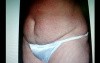 Abdominoplasty - plastic surgery