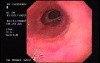 Lower Esophageal (Schatzki) Ring