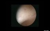 Proliferative Endometrium Polypoid Appearance Genesis Of Polyps 