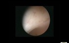 Proliferative Endometrium Polypoid Appearance Genesis Of Polyps 