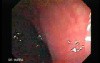 Status Post Rubber Band Ligation for Internal Hemorrhoids (2 of 7)