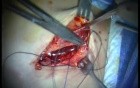 Autologous Bone Grafting (2/4)