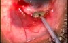 Neovascular glaucoma - 80 years old patient

