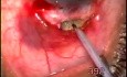 Neovascular glaucoma - 80 years old patient
