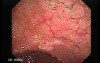 Familial Adenomatous Polyposis (18 of 36)