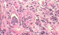 Early Gastric Cancer (19 of 21)