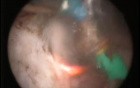 Transurethral Vaporesection Of The Prostate