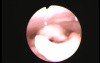 Restored Voice by False Vocal Folds Compensation