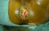External Haemorrhoids
