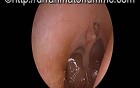 Atrophic & Atelectatic Eardrum