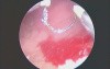 Bladder Cancer