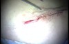 Autologous Bone Grafting (4/4)