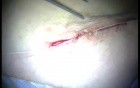 Autologous Bone Grafting (4/4)