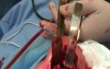 The Superior Rhinotomy For Inverting Papilloma