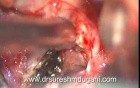 Colloid Cyst 3rd Ventrical - Trans Cortical, Trans Ventrical Microsurgical Total Excision