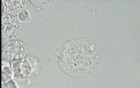 Trichomoniasis - Trichomonas vaginalis