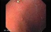 Gastric Cancer - Intestinal Metaplasia - Endoscopy (2 of 7)