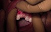 Guided Implant (NobelGuide) Part 10/10-Implant PlacementCEREC