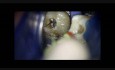 Middlemesial Canal In Mandibular Molar