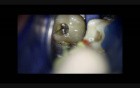 Middlemesial Canal In Mandibular Molar