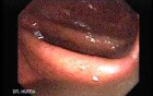 Massive Rectal Bleeding (6 of 11)