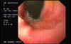 Flexible Endoscopic Suturing - 35 Years-Old Male