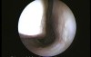Normal Nasal Cavity - Endoscopic Examination
