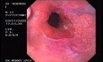 Banding of esophageal varices (1 of 17)