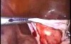 Laparoscopic Management Of Ovarian Cyst