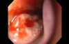 Severe Epistaxis - Case Study  (7 of 8)
