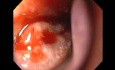 Severe Epistaxis - Case Study  (7 of 8)