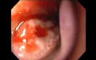 Severe Epistaxis - Case Study  (7 of 8)