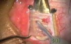 Bloodless Strabismus Surgery - Fugo Blade