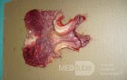 Endoscopy of Scirrhous Gastric Carcinoma involving the entire Fundus, Body and the Antrum (42 of 47)