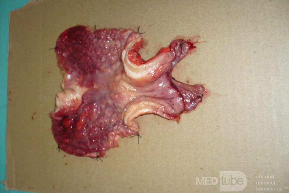 Endoscopy of Scirrhous Gastric Carcinoma involving the entire Fundus, Body and the Antrum (42 of 47)